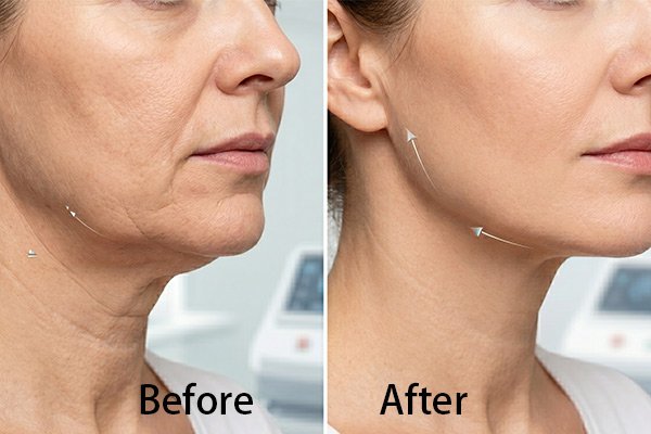 Before & After