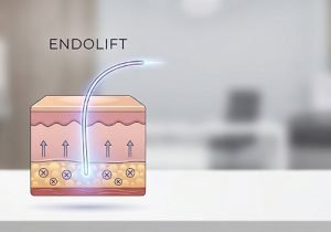 How Endolift Works