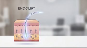 How Endolift Works